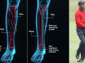Chấn thương đầu gối trái khi đánh golf