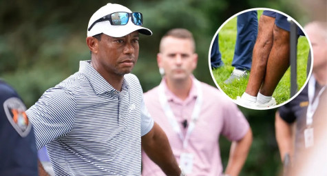 Cận cảnh chấn thương chân phải của Tiger Woods được tiết lộ