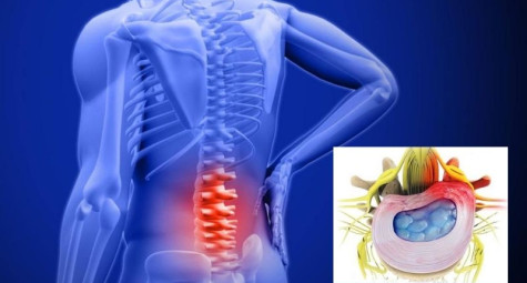 Hiểu rõ về phình đĩa đệm để phòng tránh đúng cách