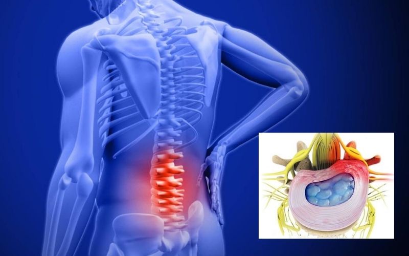 Hiểu rõ về phình đĩa đệm để phòng tránh đúng cách